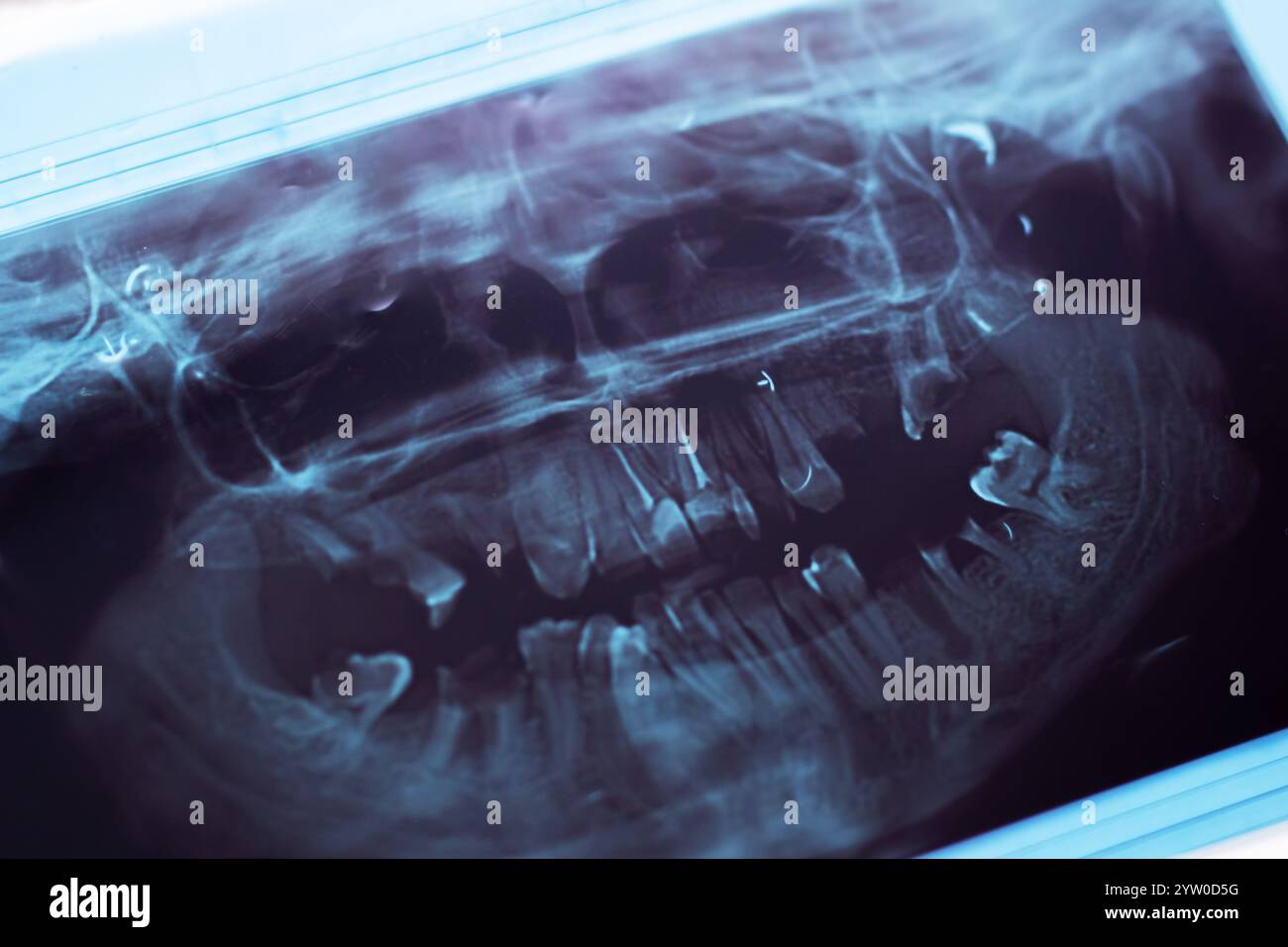 This is a closeup image presenting an xray capturing the dental ...