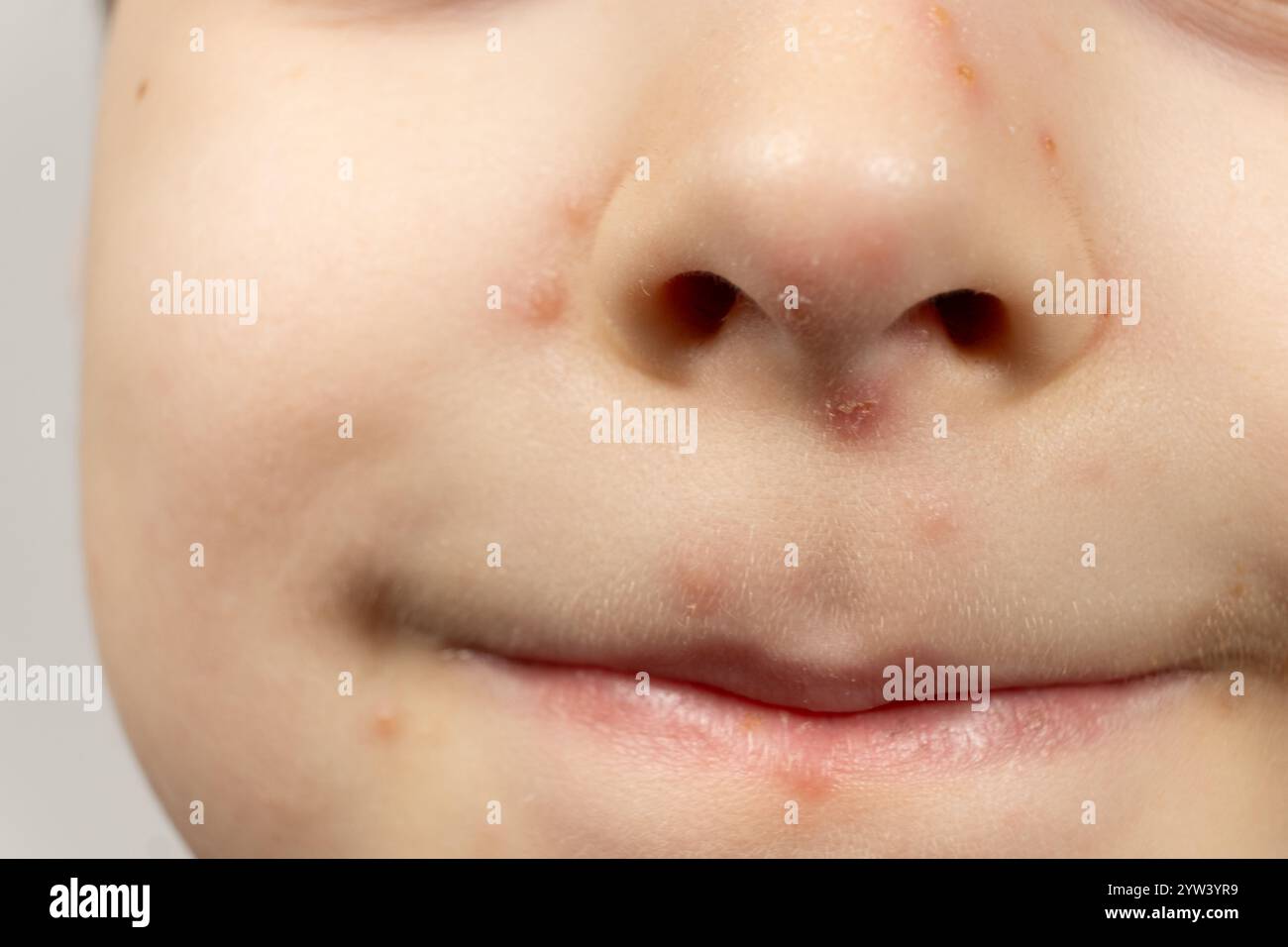 Skin of a child with symptoms of chickenpox, skin rash Stock Photo - Alamy