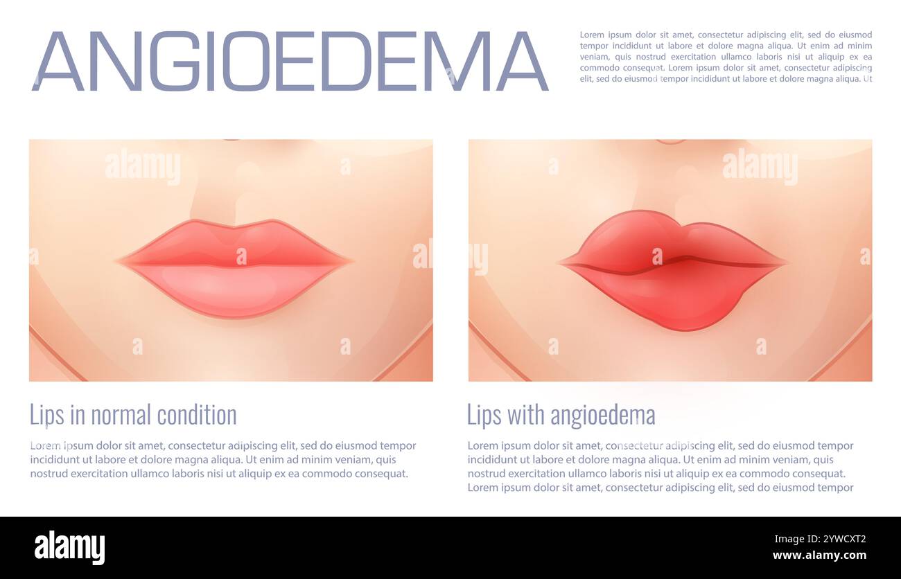 Angioedema Lips And Eyes