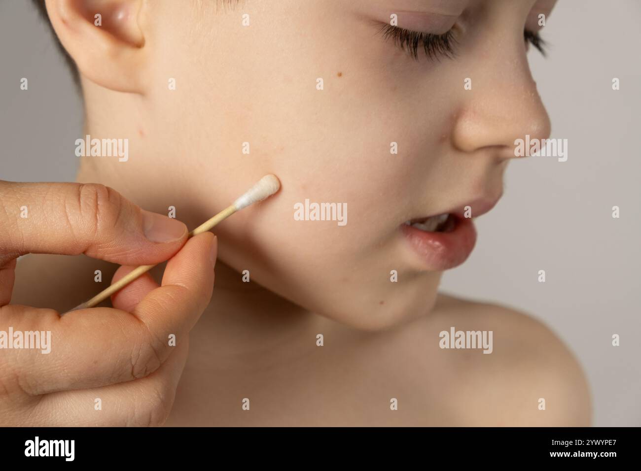 Treatment of chickenpox, application of an antipruritic and anti-inflammatory agent to the vesicles. Stock Photo