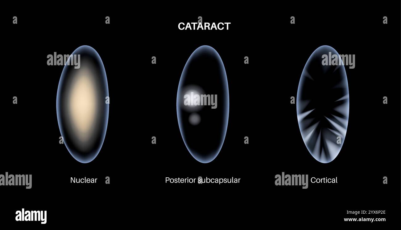 Cataract eye disease, illustration Stock Photo - Alamy