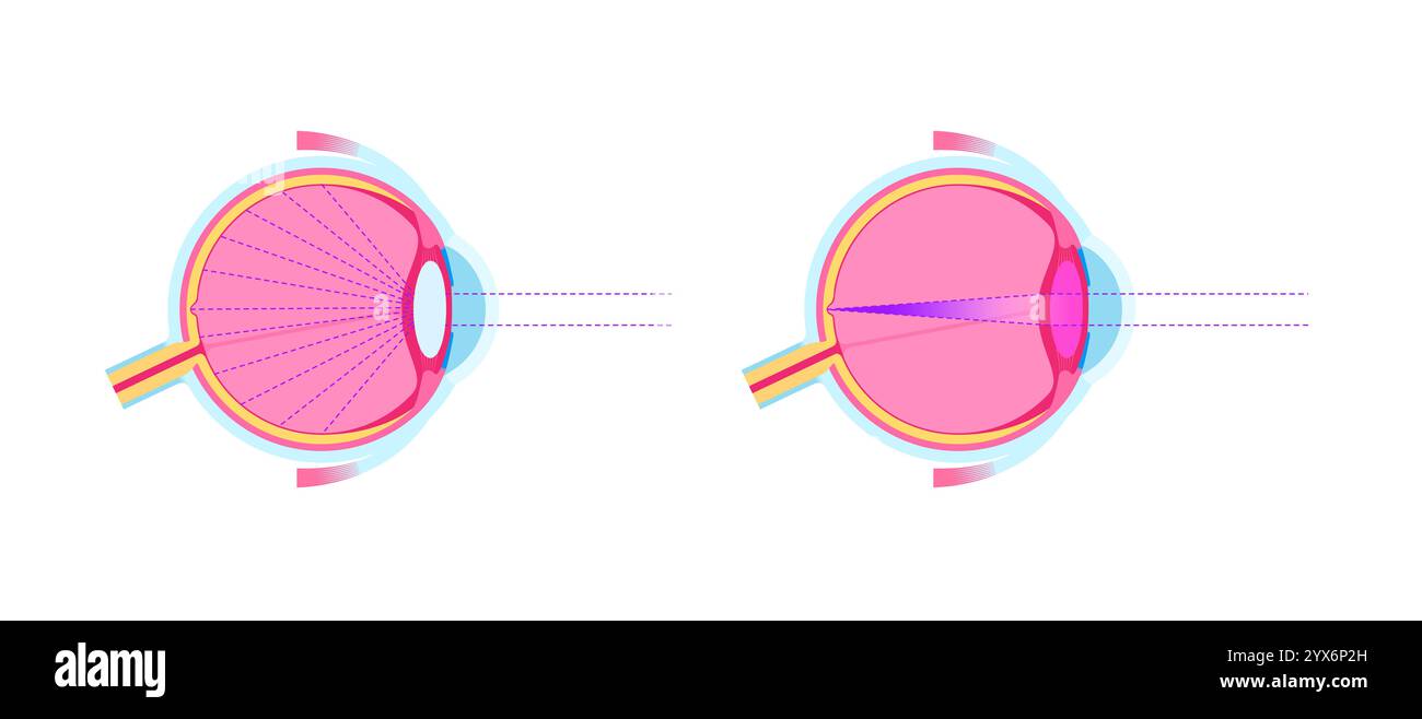 Cataract eye disease, illustration. Stock Photo