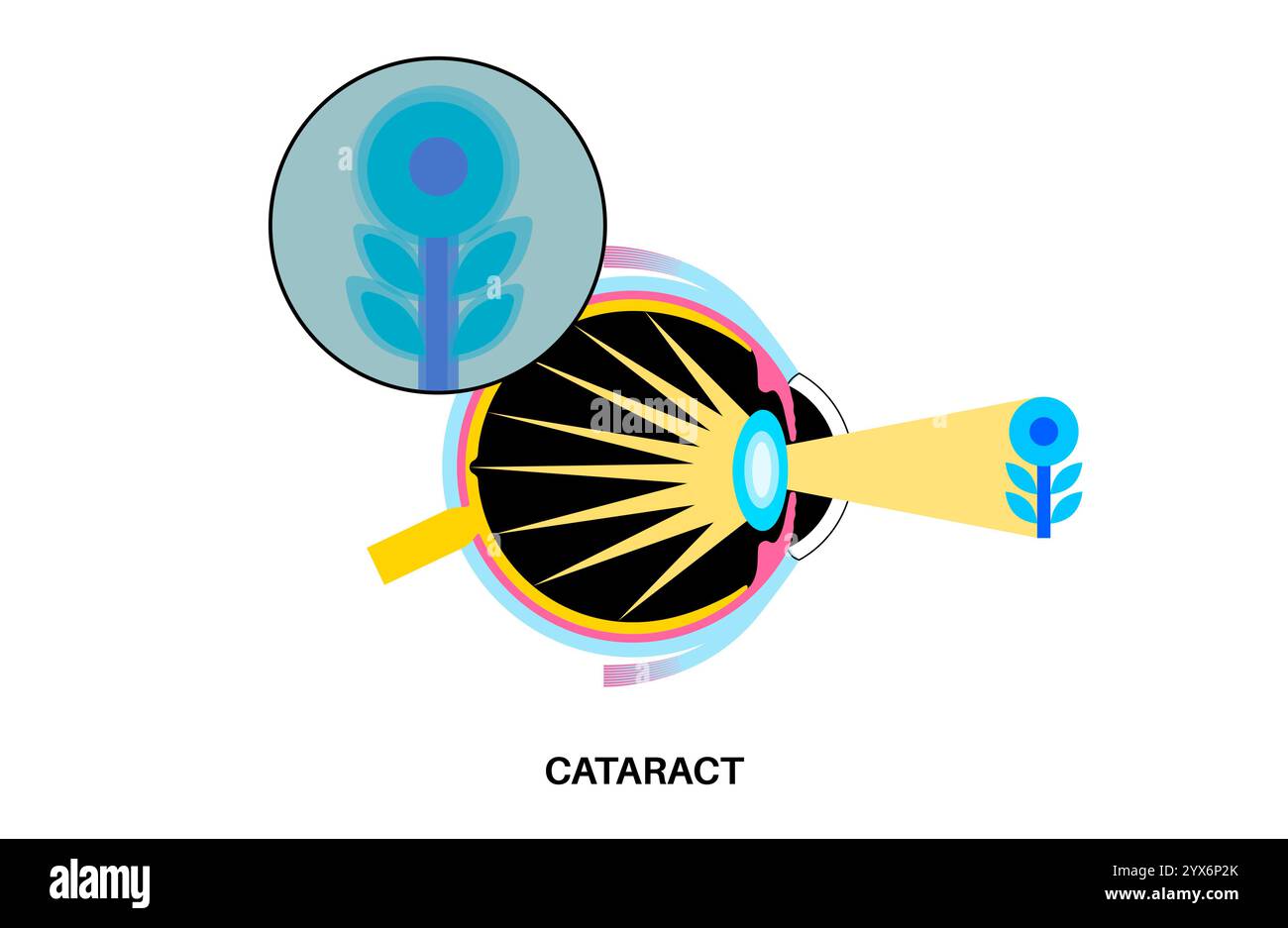 Cataract eye disease, illustration Stock Photo - Alamy