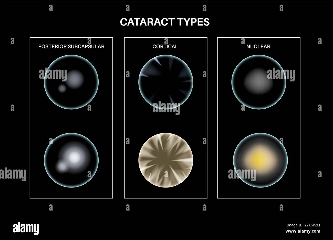 Cataract eye disease, illustration. Stock Photo