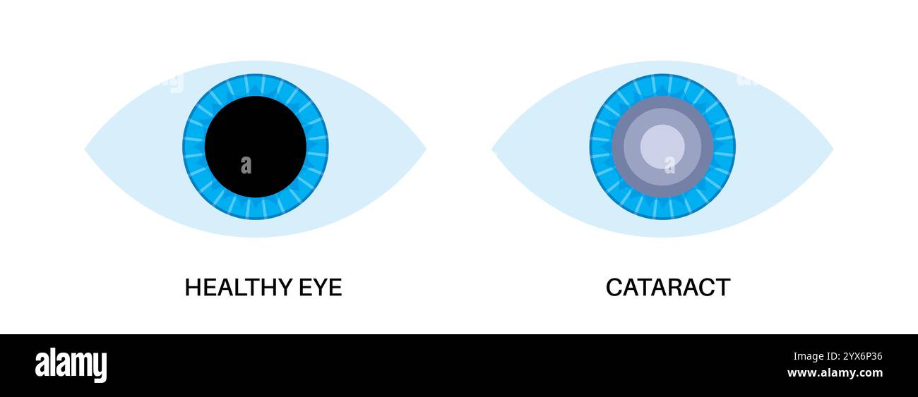 Cataract eye disease, illustration. Stock Photo