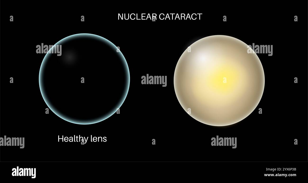 Cataract eye disease, illustration. Stock Photo