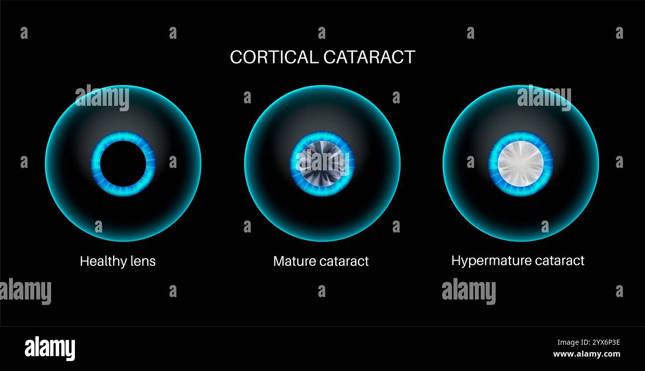 Eye disease cataract hi-res stock photography and images - Alamy