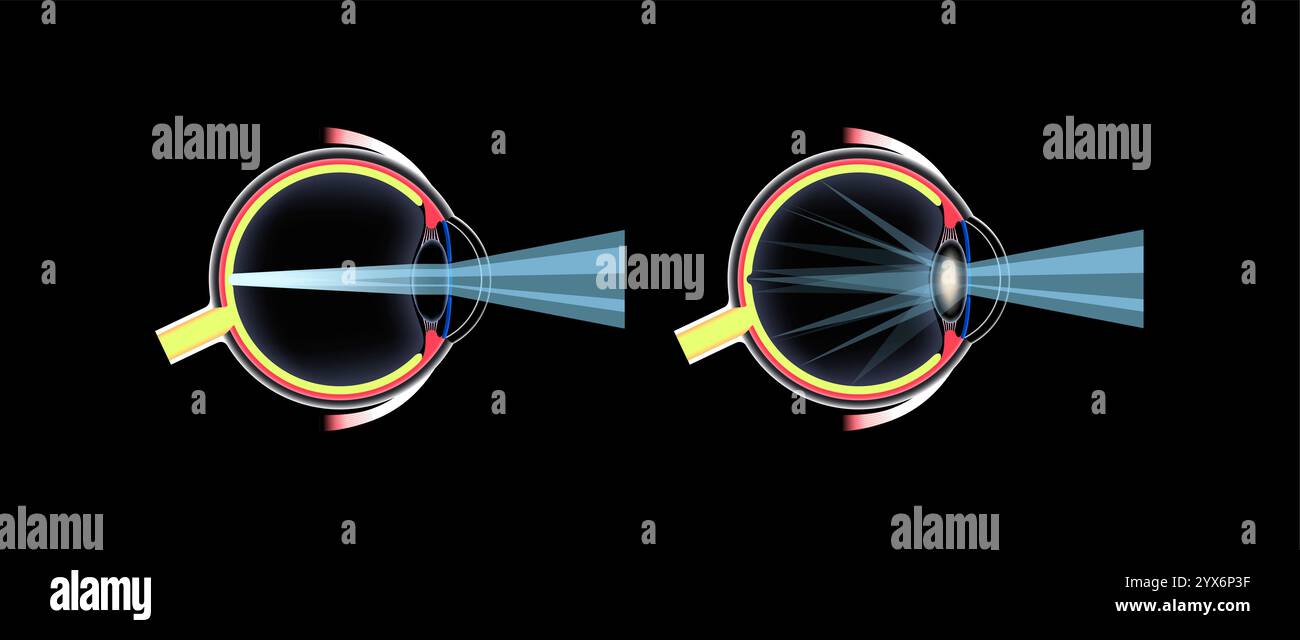 Cataract eye disease, illustration. Stock Photo