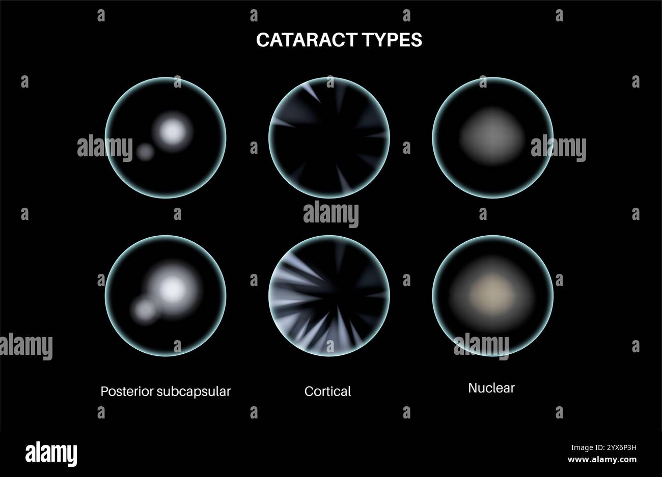 Cataract eye disease, illustration. Stock Photo