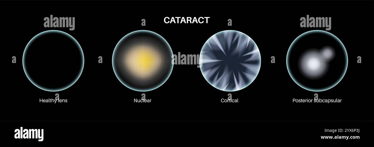 Cataract eye disease, illustration. Stock Photo