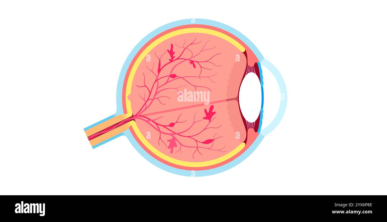 Diabetic retinopathy, illustration. Stock Photo