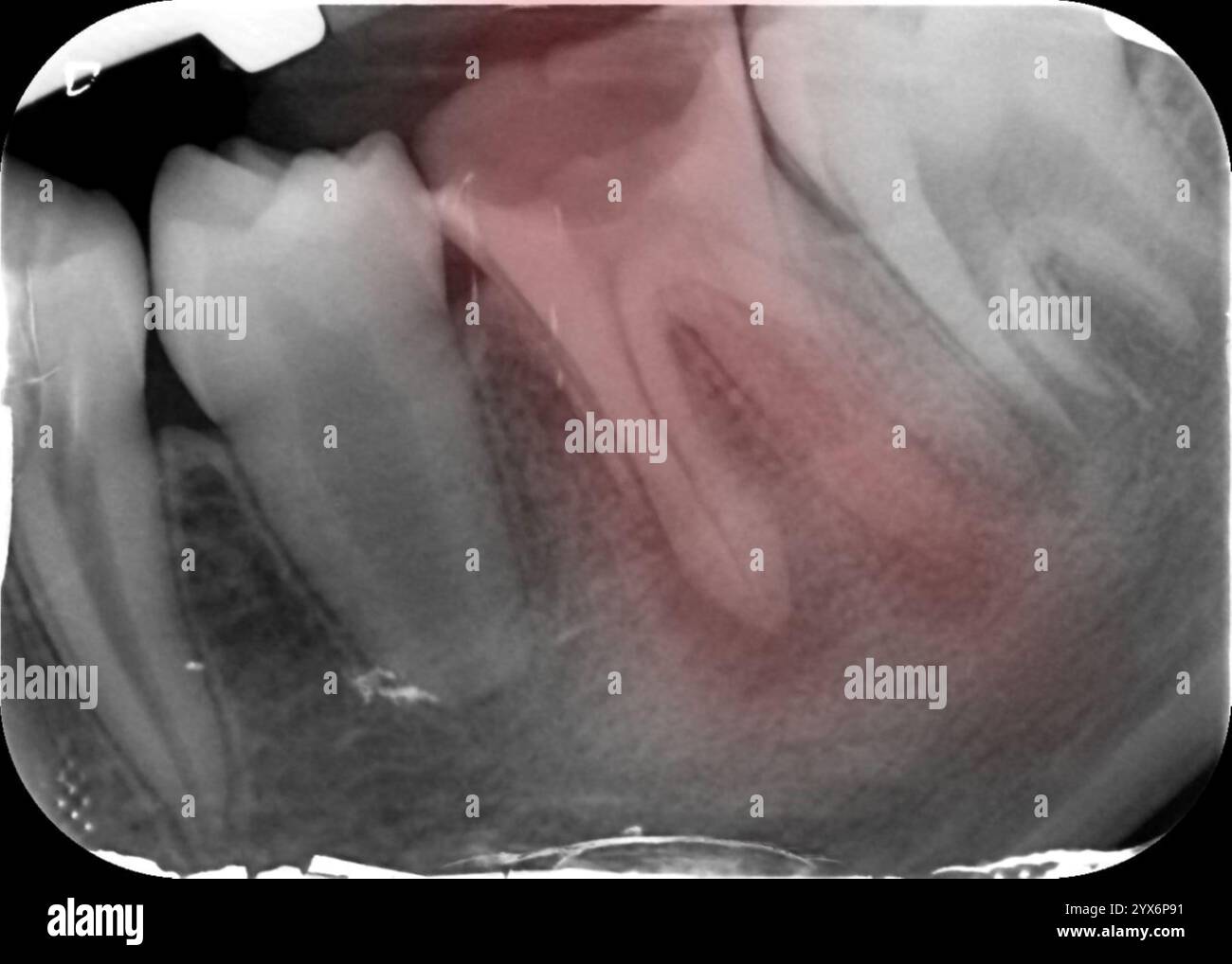 Coloured periapical X-ray of a mandibular left first molar tooth showing cavities, or caries, and a periapical (around the apex of the tooth root) lesion that is suggestive of a periapical abscess. A periapical X-ray shows the entire tooth, from the crown to the root tip. Stock Photo