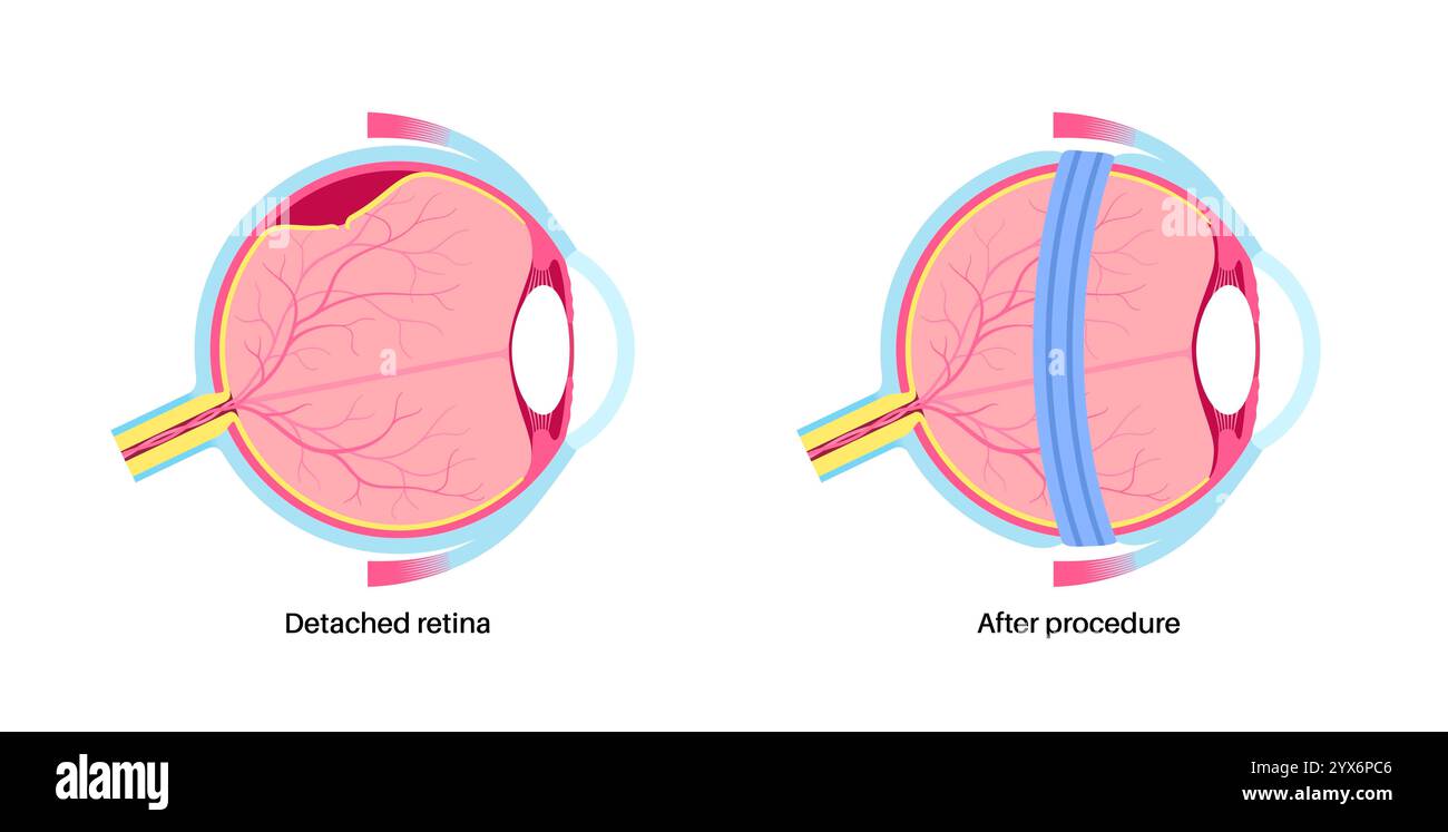 scleral-buckle-procedure-illustration-this-is-a-procedure-used-to