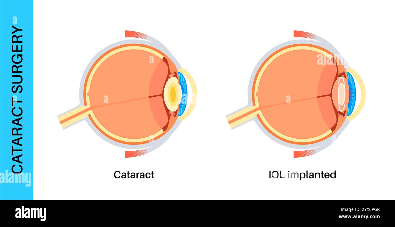 Intraocular lens implantation, illustration. Stock Photo