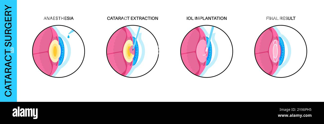 Cataract surgery, illustration. Stock Photo