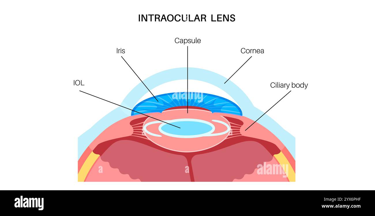 Intraocular lens implantation, illustration. Stock Photo