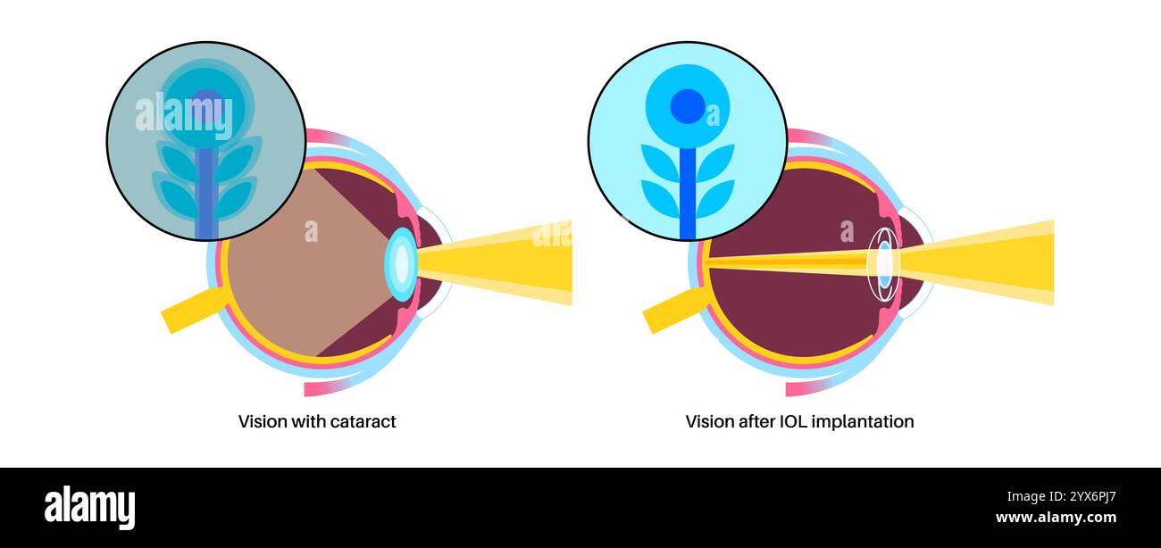 Intraocular lens implantation, illustration. Stock Photo