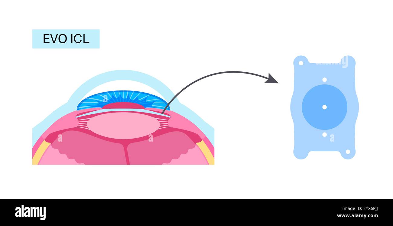 Implantable collamer lens surgery, illustration. Stock Photo