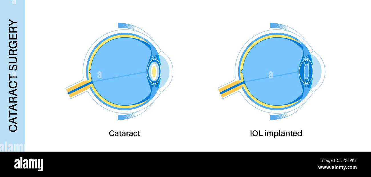 Intraocular lens implantation, illustration. Stock Photo