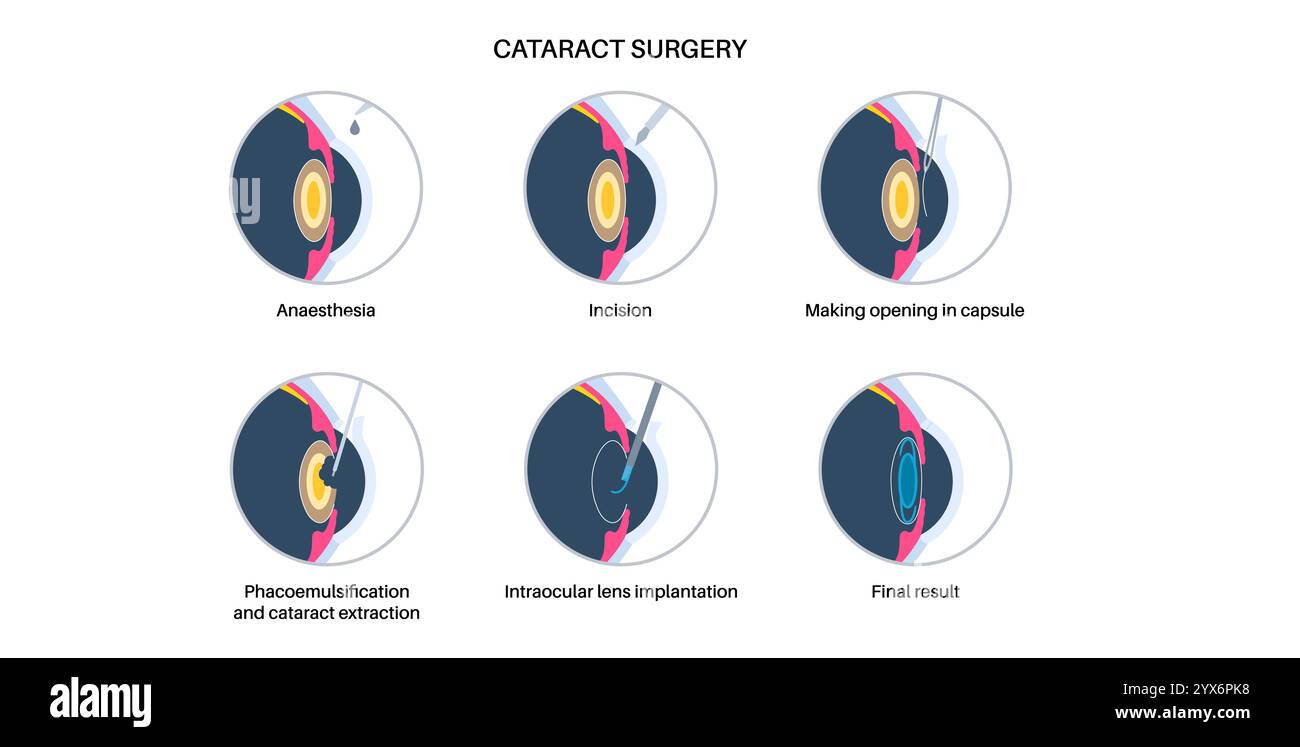 Cataract surgery, illustration. Stock Photo