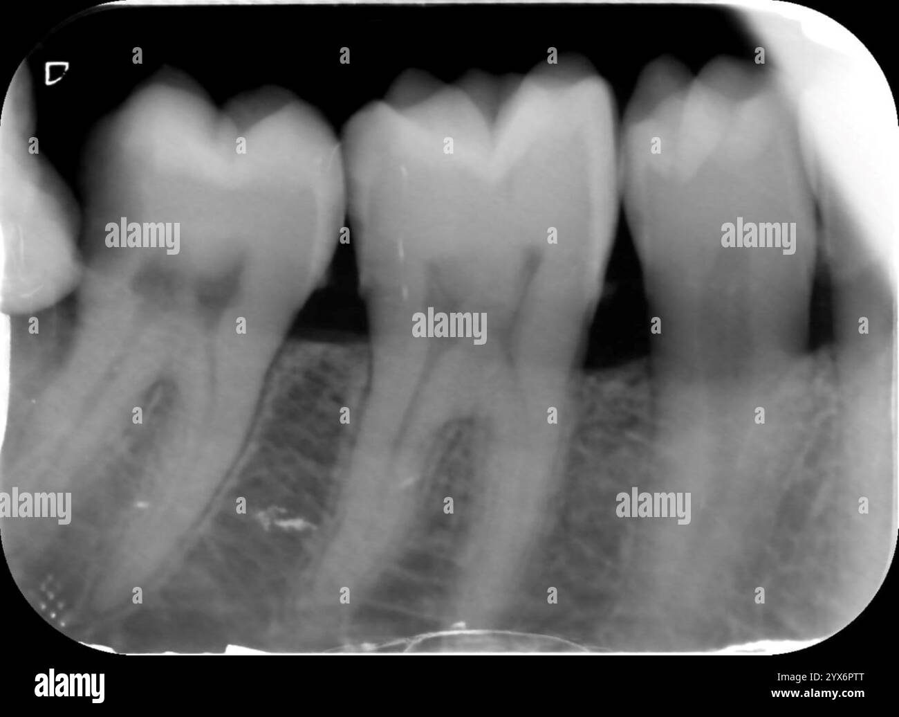 Periapical X-ray of a healthy right lower premolar and the first and second molars. A periapical X-ray shows the entire tooth, from the crown to the root tip. Stock Photo