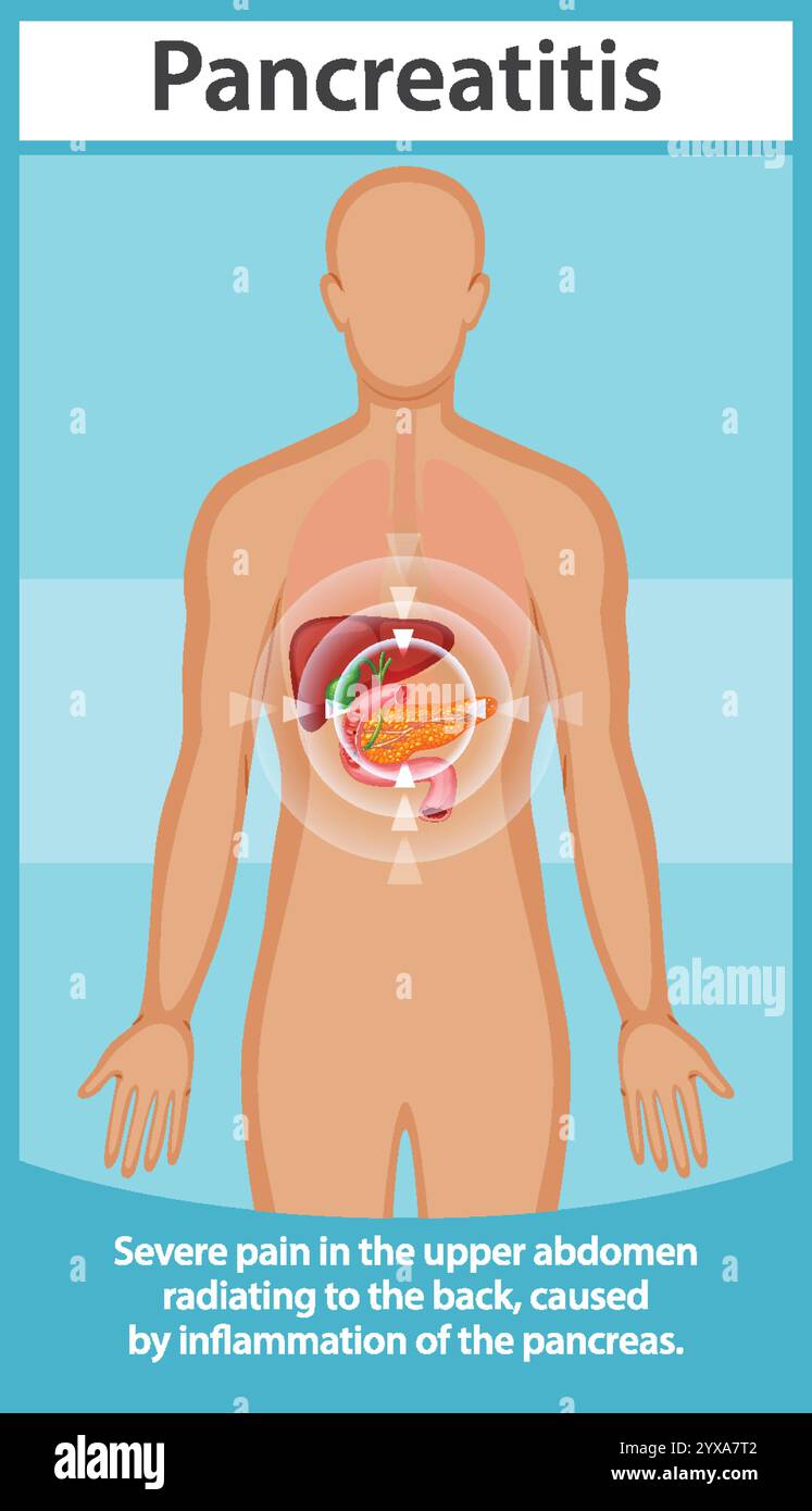 Organ Radiating Pain Radiating pain illustration hi-res stock photography and images - Alamy