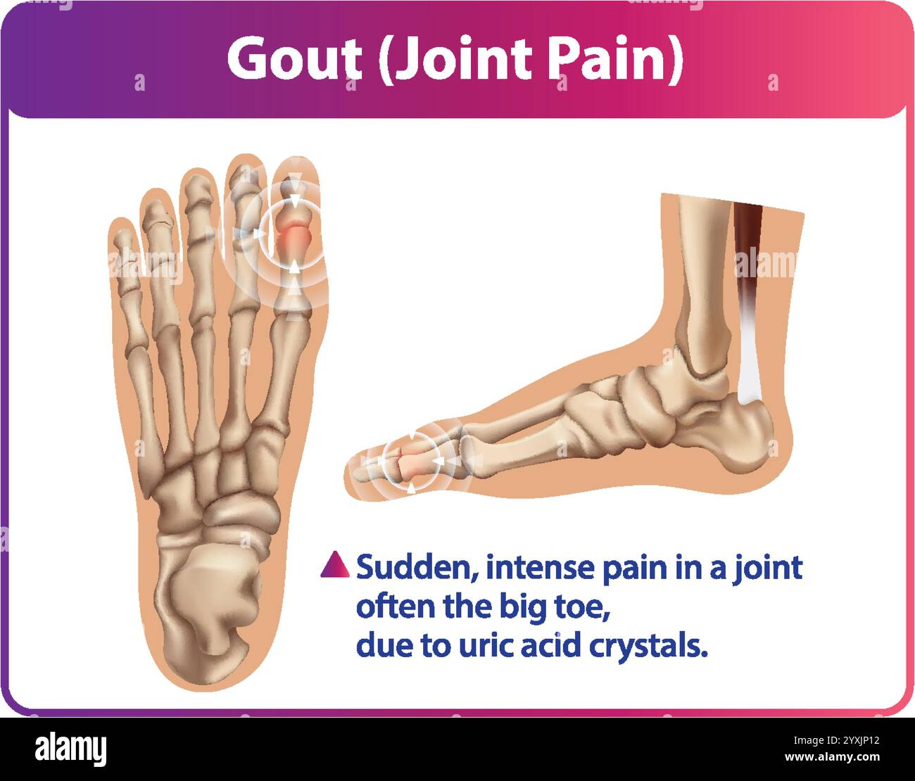 Illustration of gout affecting the foot joints Stock Vector Image & Art ...