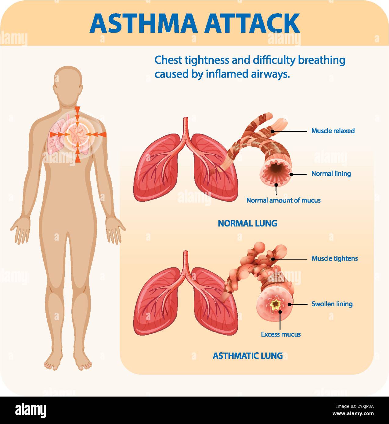 Illustration of normal and asthmatic lung conditions Stock Vector Image ...