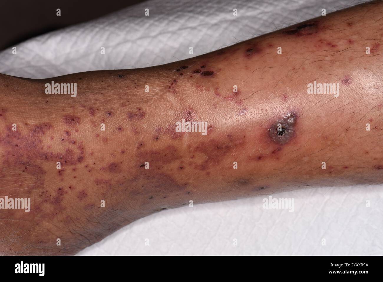 IgA (immunoglobulin A) vasculitis rash on the leg of a 55 year old ...