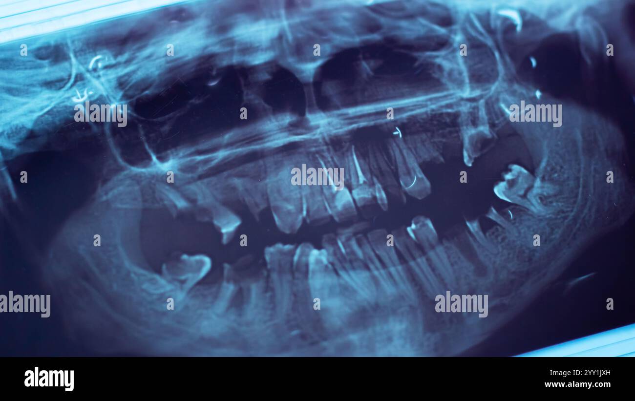 This is a closeup image presenting an xray capturing the dental ...