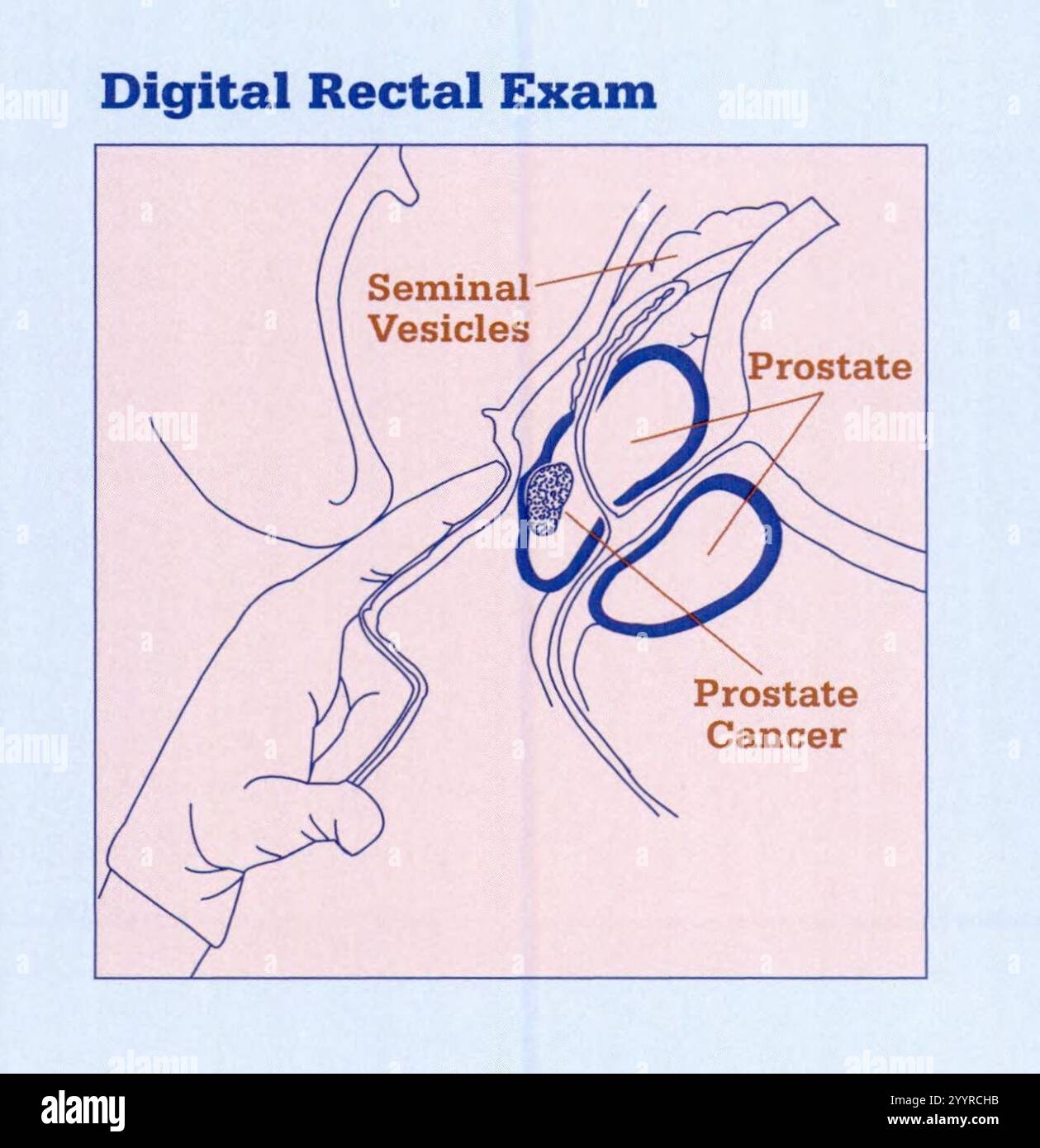 High Riding Prostate Sign Digital Rectal Exam, extracted from Understanding treatment choices for ...