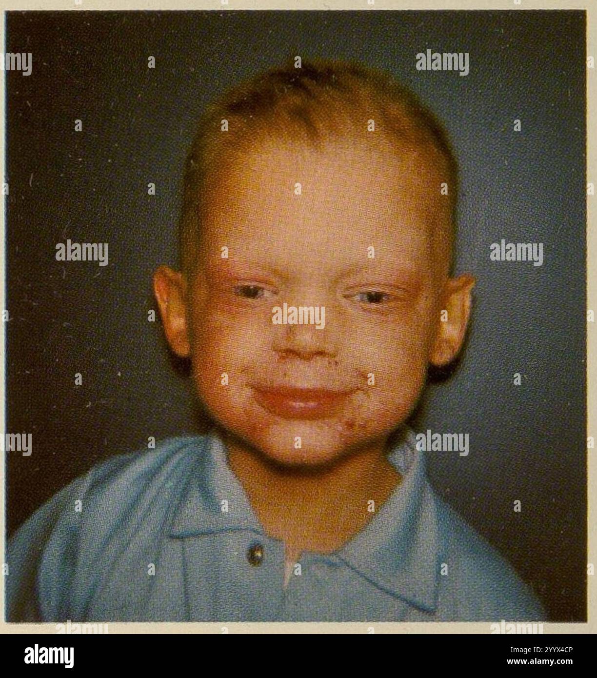 Ectodermal Dysplasia 3 Stock Photo - Alamy