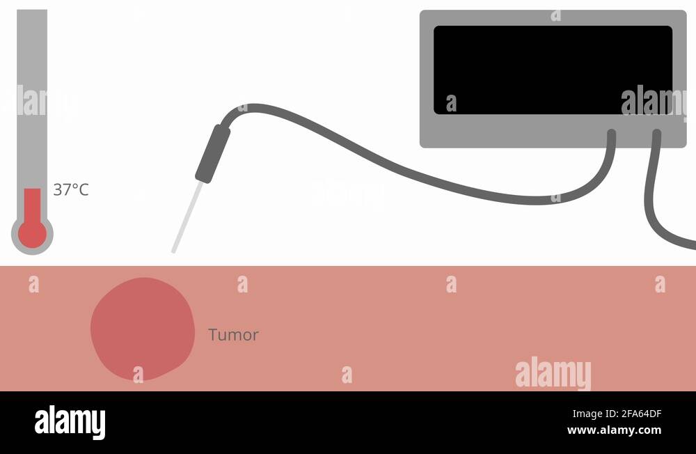 Electrosurgery Radiofrequency Ablation Animation with Labeling Stock