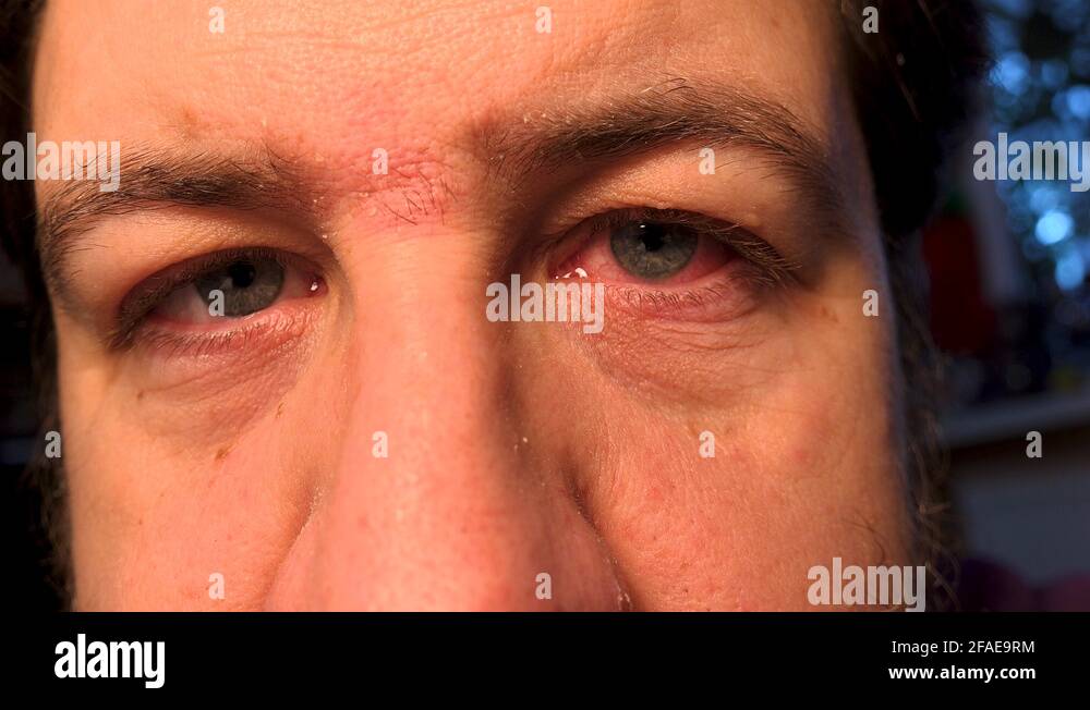 Irritated eye Stock Videos & Footage HD and 4K Video Clips Alamy