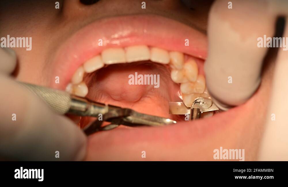Amalgam fillings Stock Videos & Footage HD and 4K Video Clips Alamy