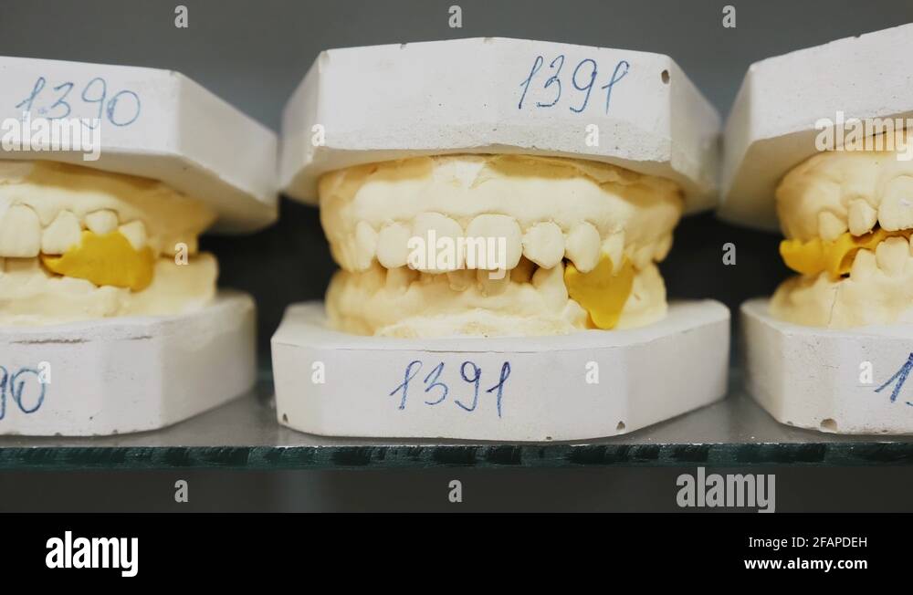 Gypsum impression of a human bite Stock Videos & Footage HD and 4K