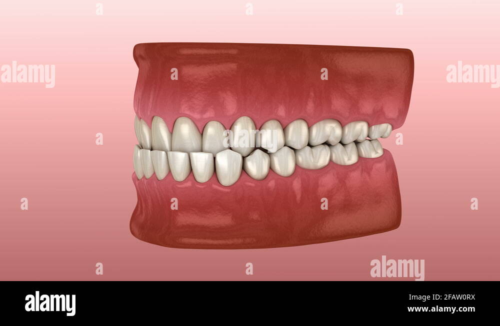 Underbite dental occlusion ( Malocclusion of teeth Stock Video Footage