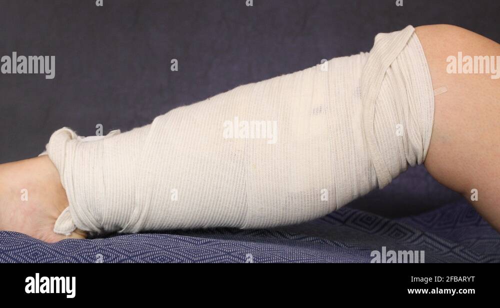 Vein bruise Stock Videos & Footage - HD and 4K Video Clips - Alamy