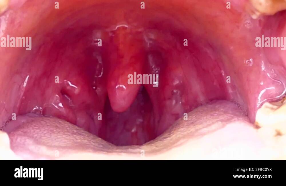 tonsils deformed, tonsillitis, neglected poor human mouth interior