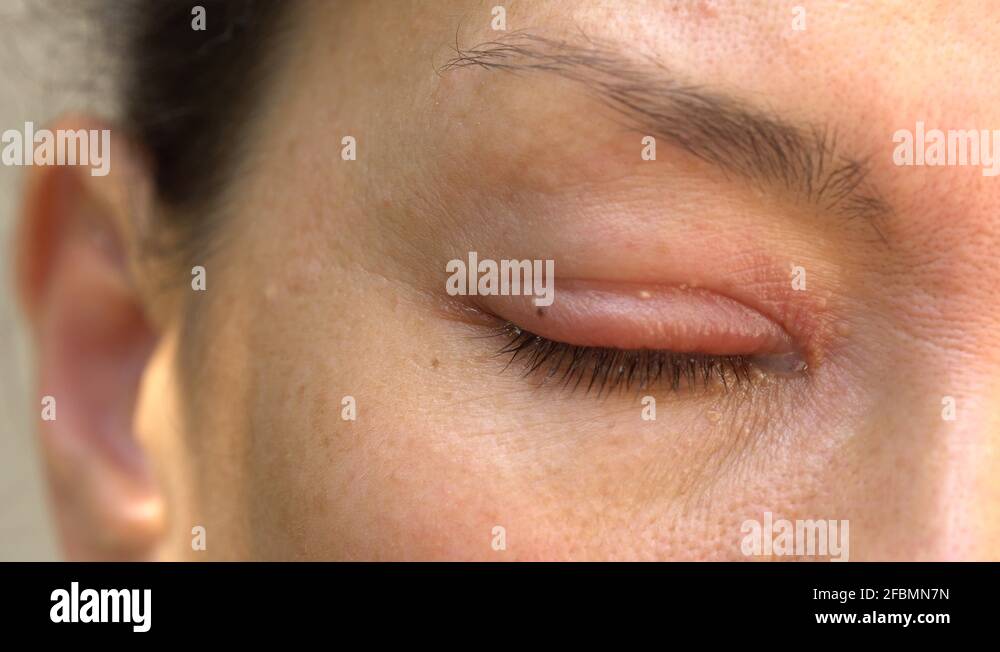 A lump on the top eyelid. Mucous discharge in the eye Stock Video Footage Alamy