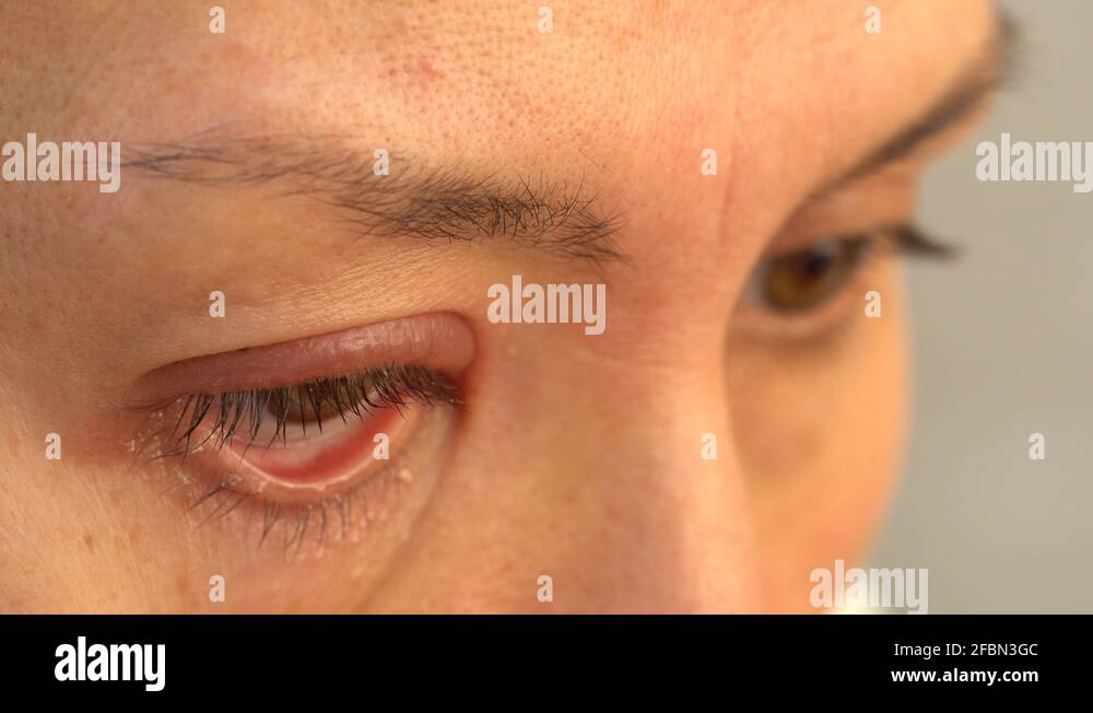 A stye, a hordeolum. Treatment. Use of antibiotic eye ointment Stock