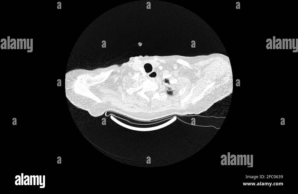 MRI footage of human body with broken rib and hematoma Stock Video ...