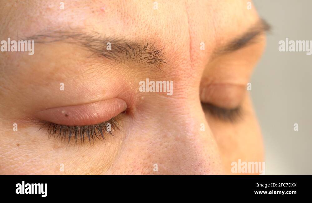 External Eyelid Stye (Hordeolum Externum Stock Video Footage Alamy