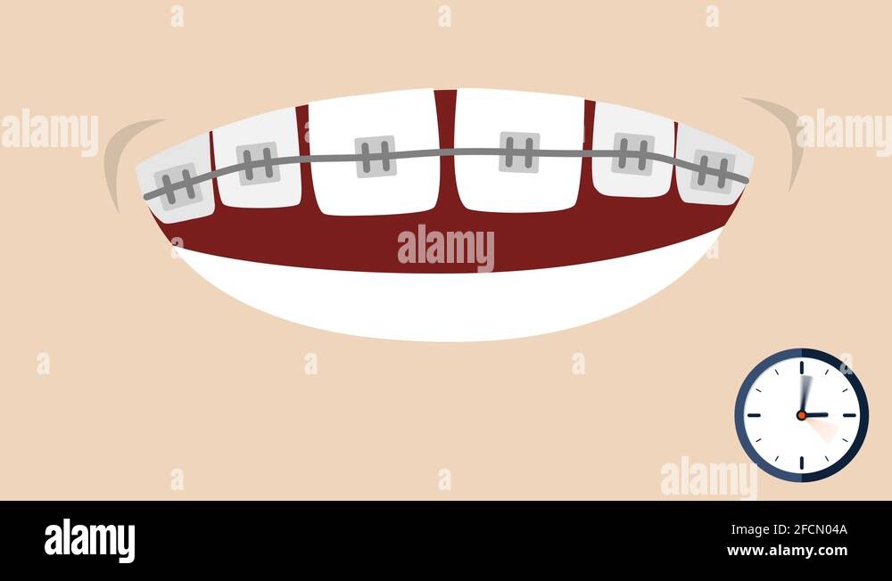 2D Animation of teeth growing back in place with braces timelapse Stock