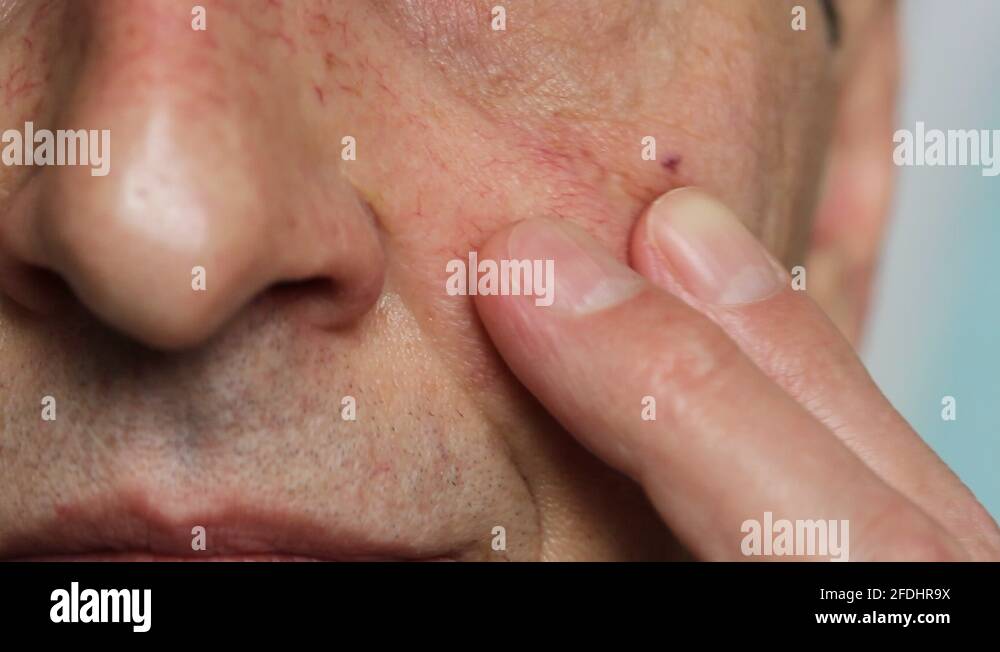 Spider veins nose Stock Videos & Footage - HD and 4K Video Clips - Alamy