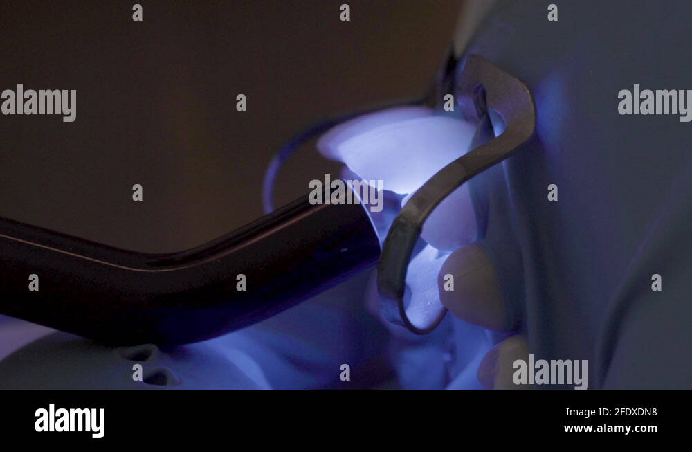 Light Curing Of Ceramic Facets Dental Veneers On False Teeth Denture