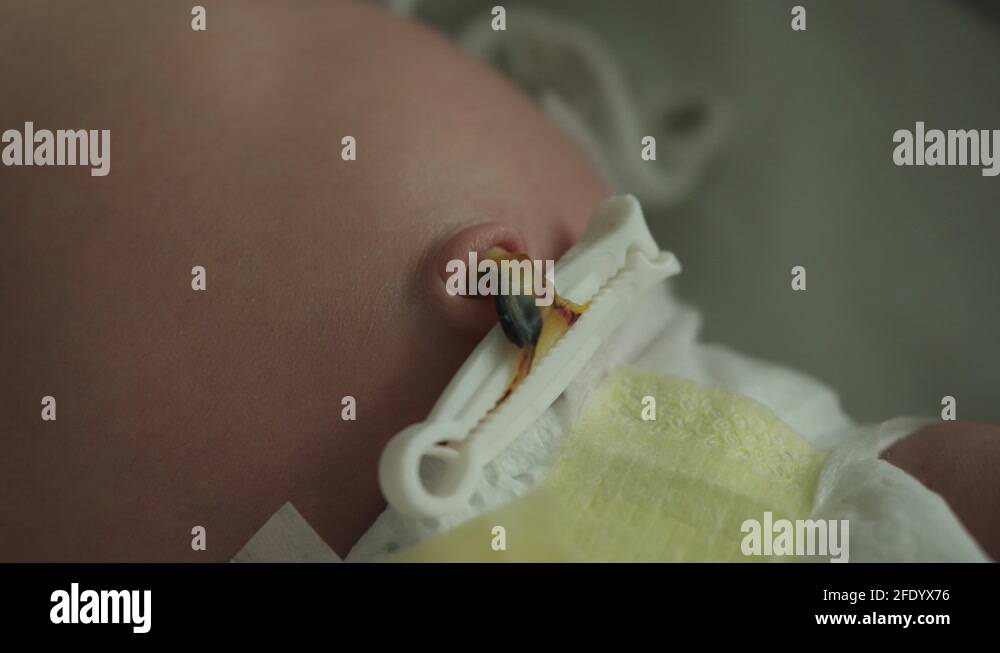 Umbilical cord clamp Stock Videos & Footage HD and 4K Video Clips Alamy