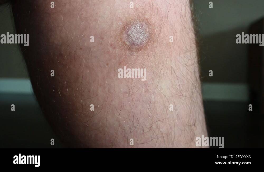 MRSA infection scar one year after large infection on the leg Stock ...