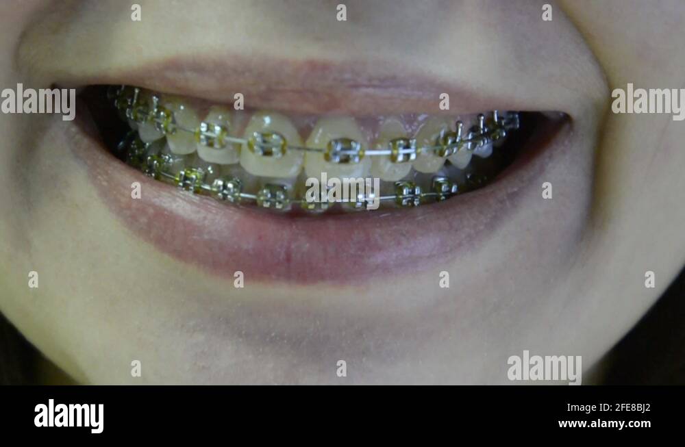 Girl braces tongue Stock Videos & Footage HD and 4K Video Clips Alamy