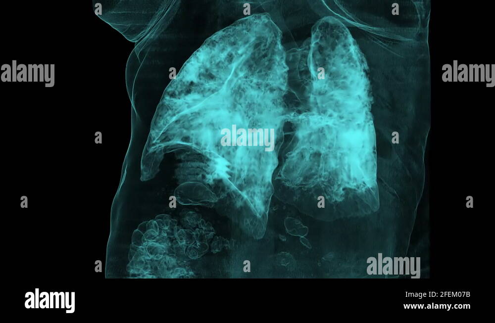 Ground glass opacity Stock Videos & Footage HD and 4K Video Clips Alamy